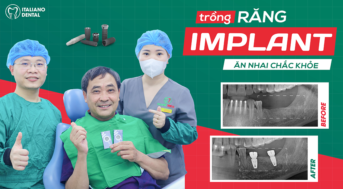  Bác sĩ trồng răng implant giỏi ở Thái Nguyên