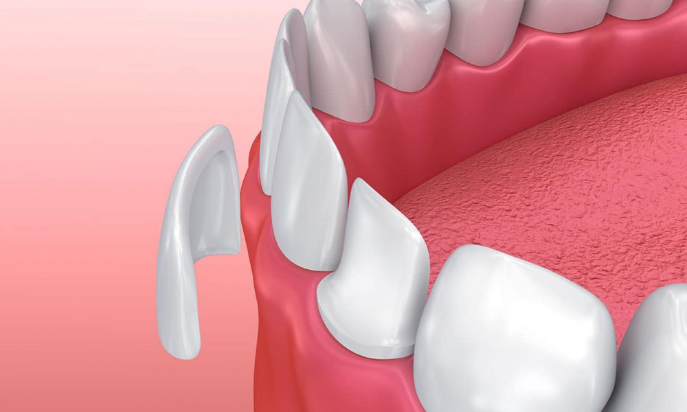 Tình trạng răng như thế nào nên dán sứ veneer