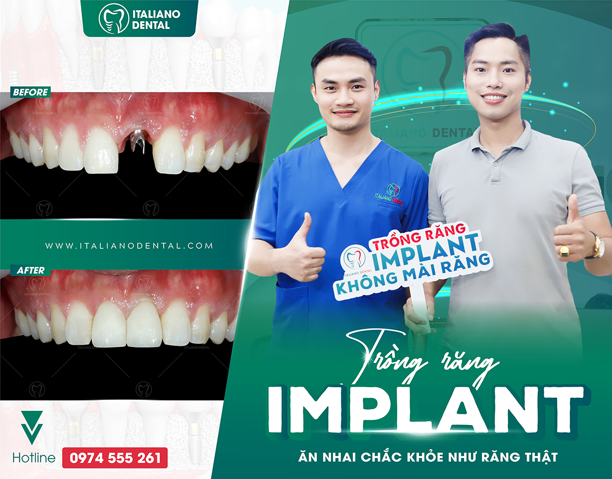 Nên trồng răng implant ở đâu Thái Nguyên