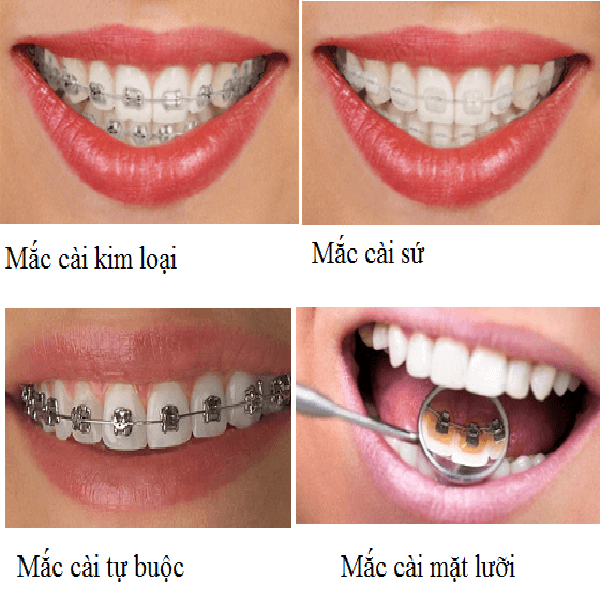 Sửa răng móm Thái Nguyên liệu có hết móm?