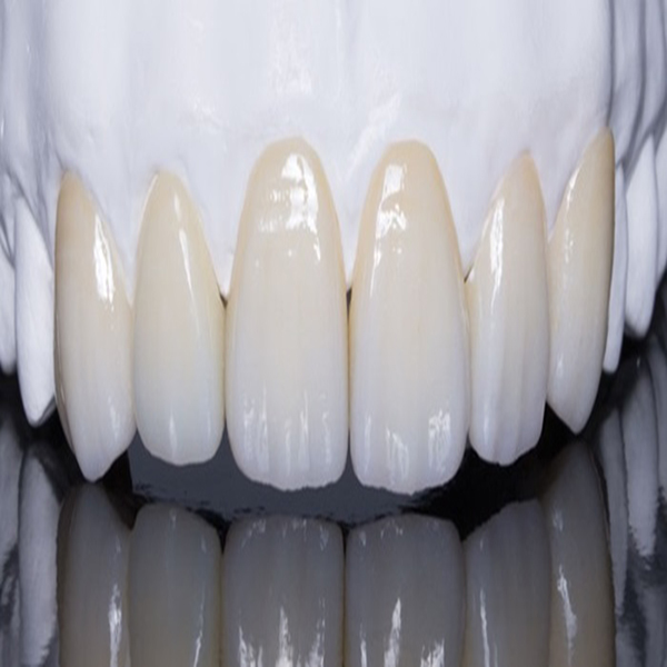 Nên bọc răng sứ hay dán sứ veneer|Lựa chọn nào cho hàm răng của bạn