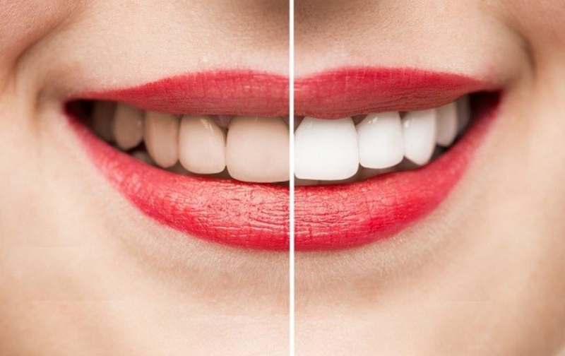 Đâu là đơn vị tẩy trắng răng tốt nhất Thái Nguyên?