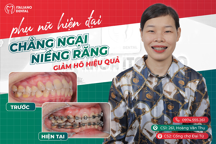 Dịch vụ niềng răng hô Bắc Giang giá rẻ có bảo hành