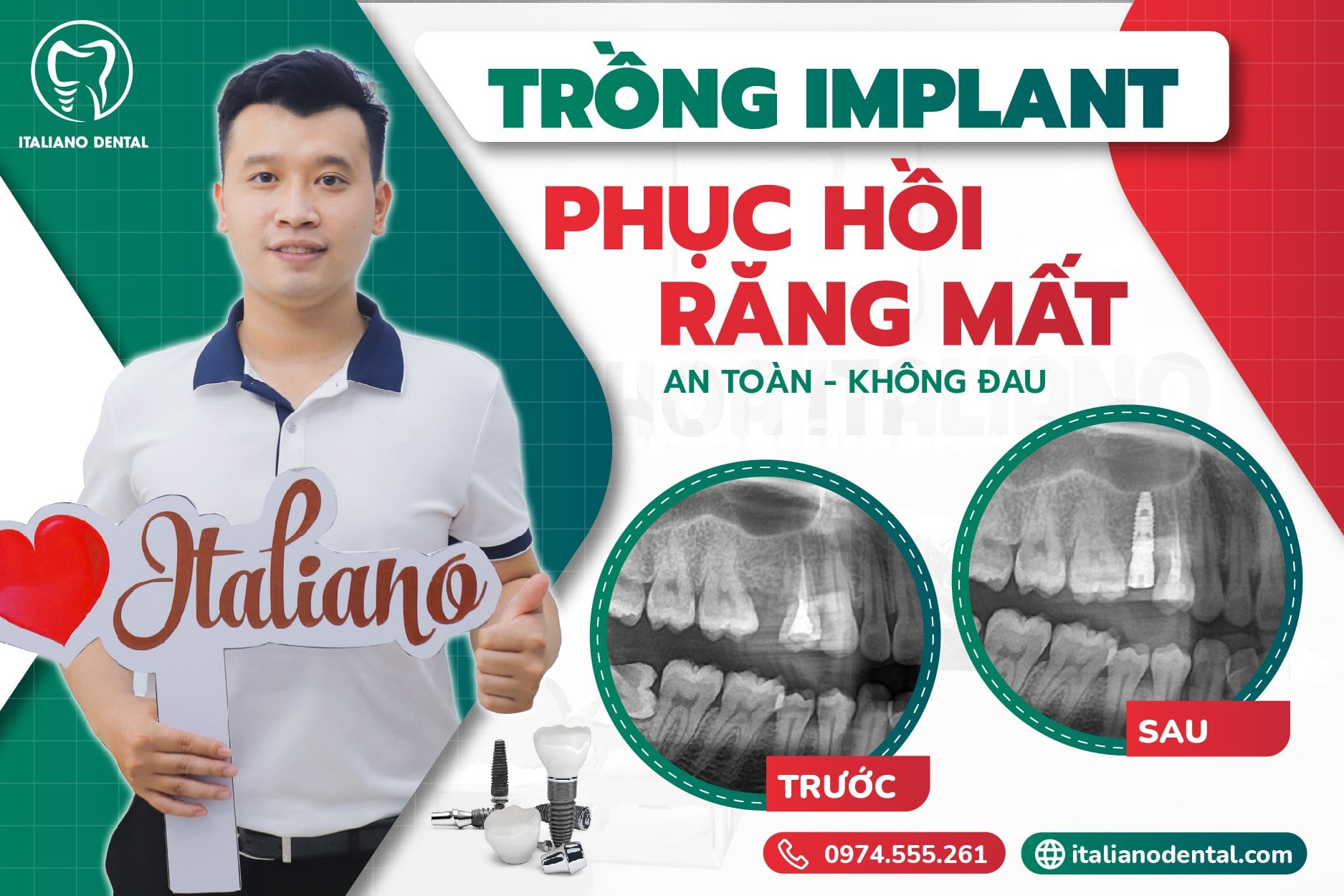  Trồng răng giả Bắc Giang bằng implant uy tín không thể bỏ qua