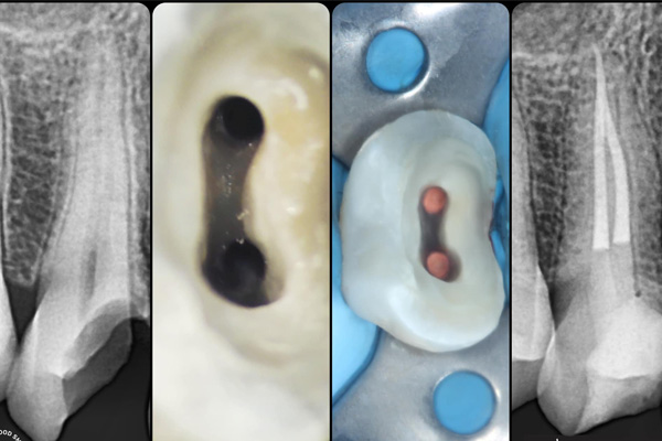 Quy trình điều trị tủy răng Bắc Giang chuẩn là như thế nào?