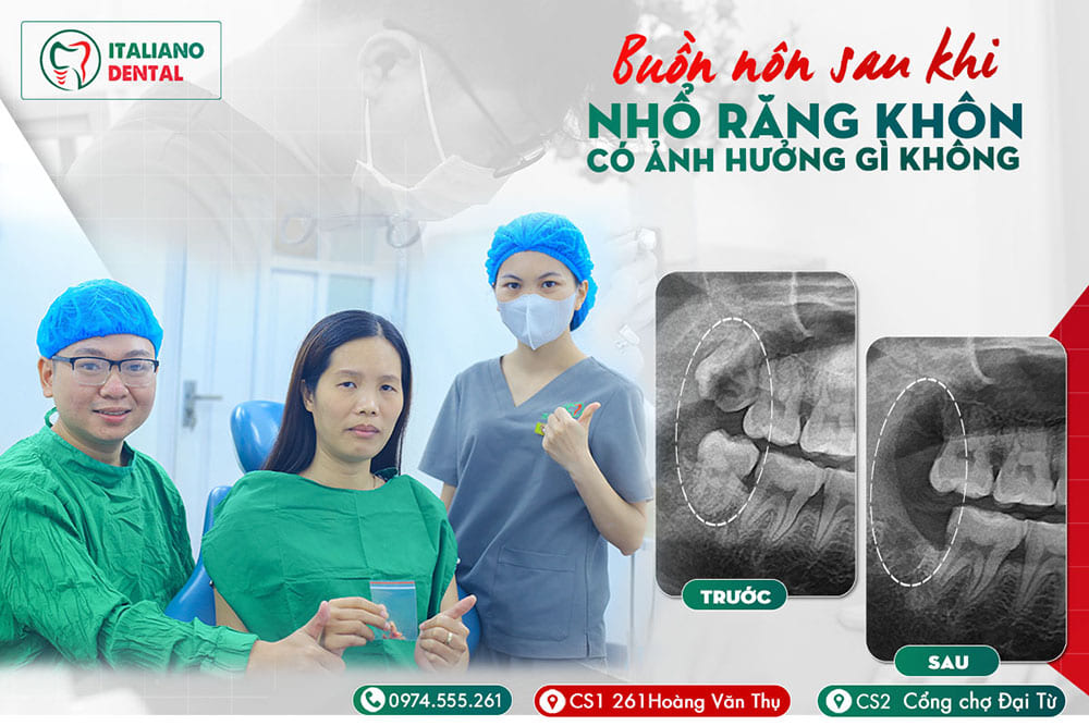 Buồn nôn sau khi nhổ răng khôn có ảnh hưởng gì không?