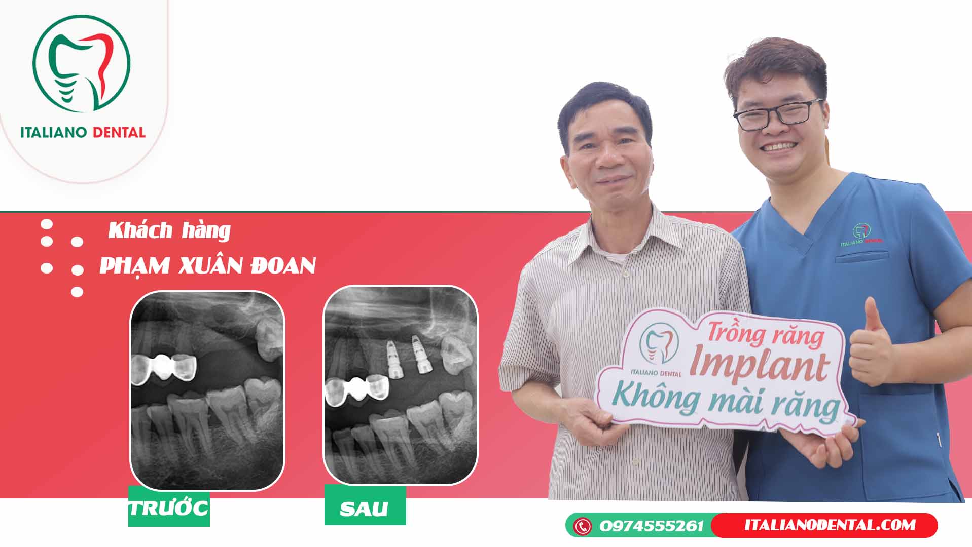 Trồng răng bằng implant hay cầu răng Thái Nguyên