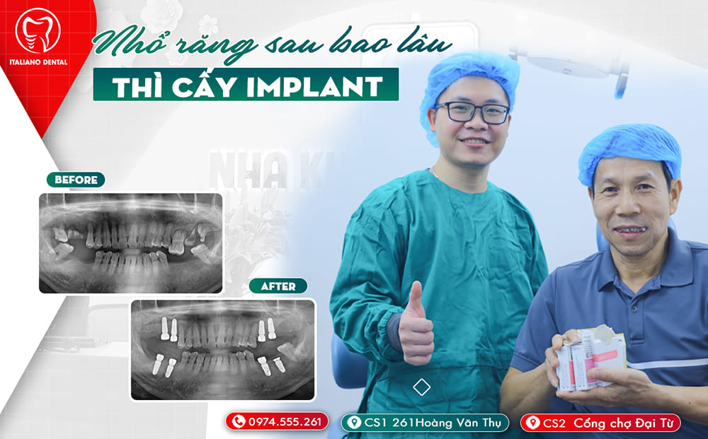 Nhổ răng sau bao lâu thì cấy implant