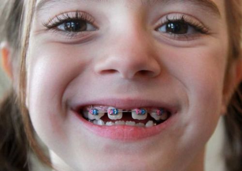 Niềng răng trẻ em cho hiệu quả điều trị nhanh và tốt hơn