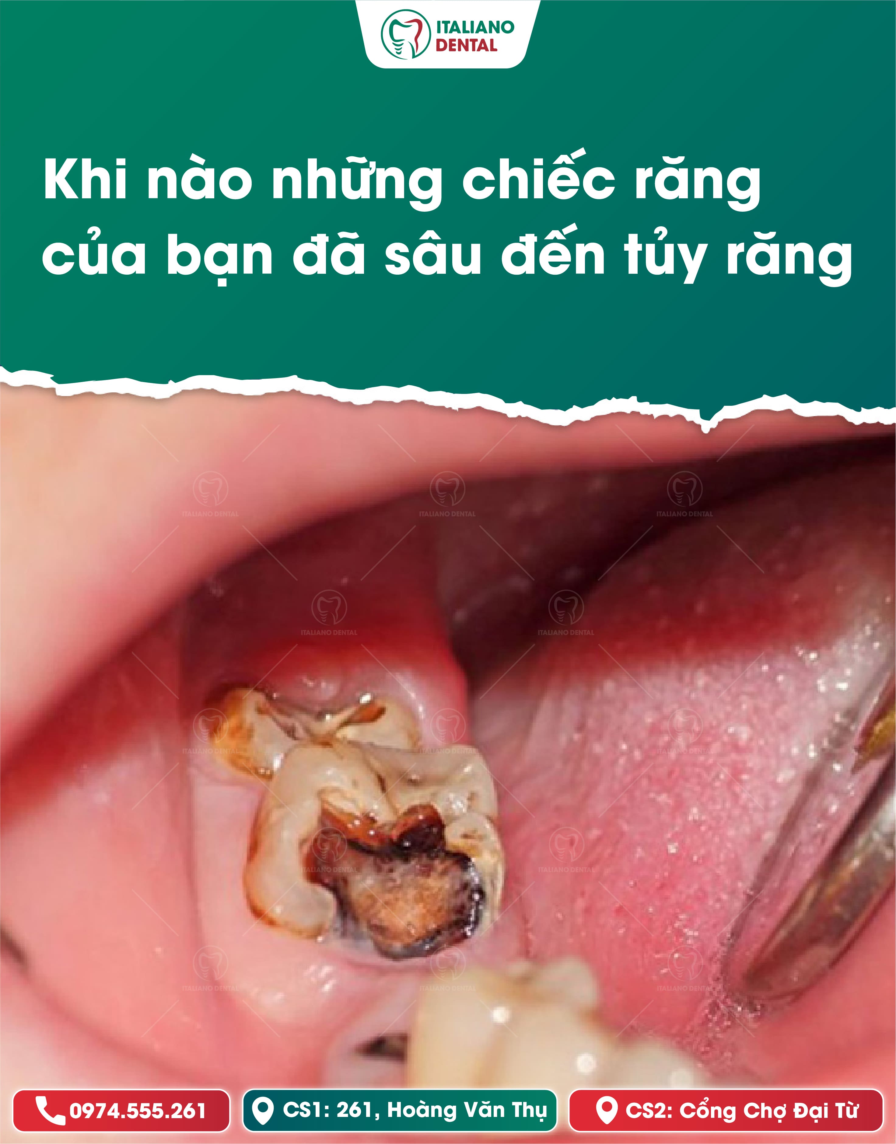 Lấy tủy răng sâu: Giải pháp bảo vệ răng hiệu quả