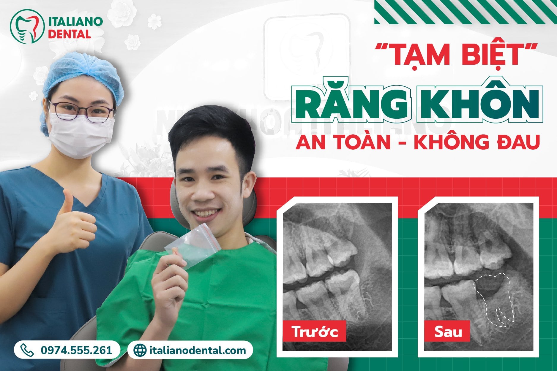 Có nên nhổ răng khôn Thái Nguyên khi chúng không bị đau hay không?