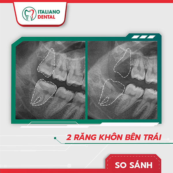 Chỗ nhổ răng khôn Thái Nguyên bị đau, nhiễm trùng sau nhổ 3 ngày nên làm gì?