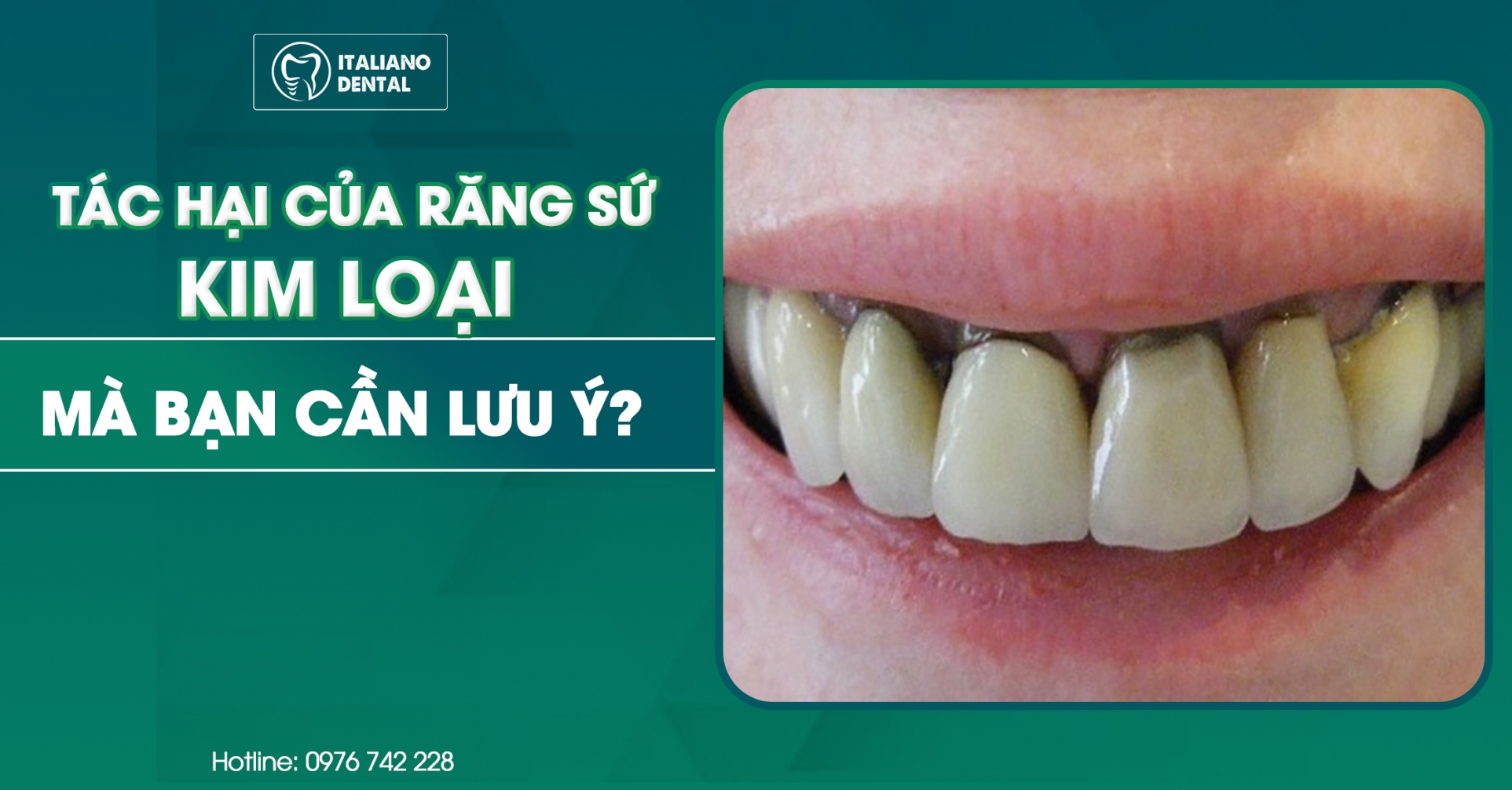 Những tác hại của răng sứ kim loại mà bạn cần lưu ý