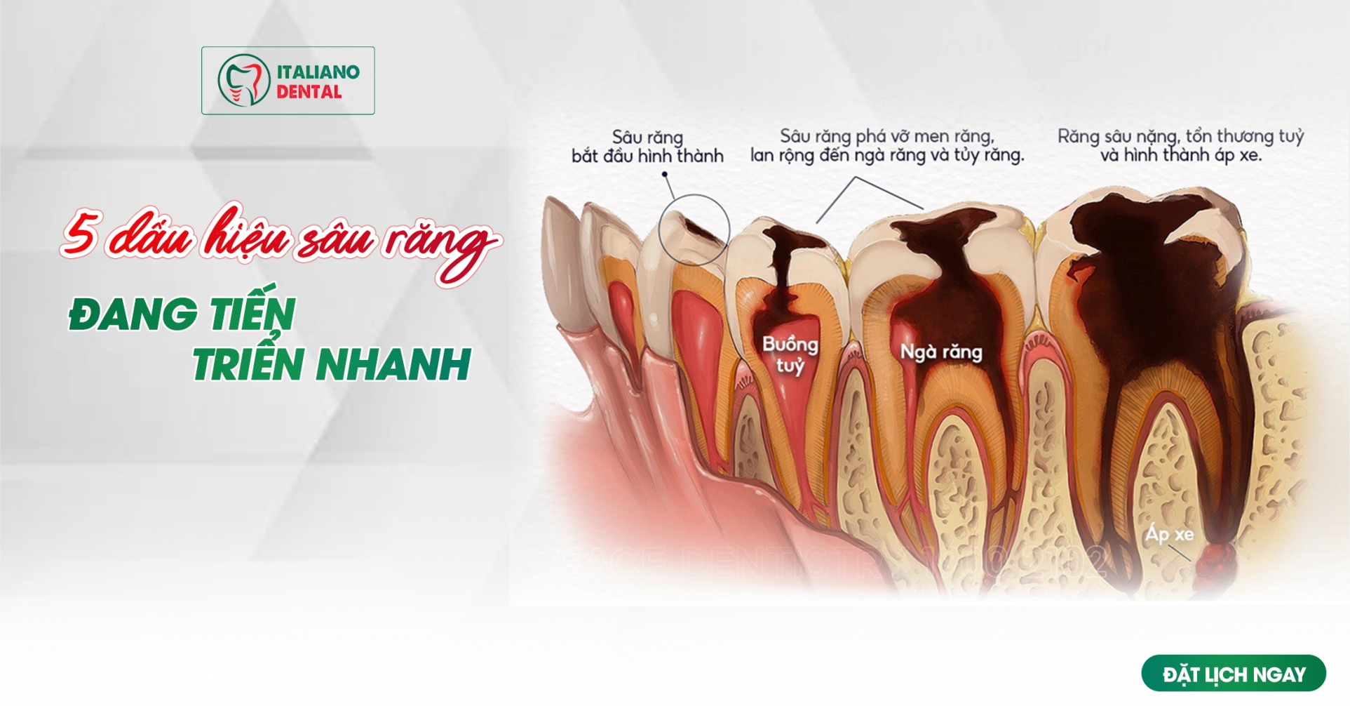 5 dấu hiệu sâu răng đang tiến triển nhanh