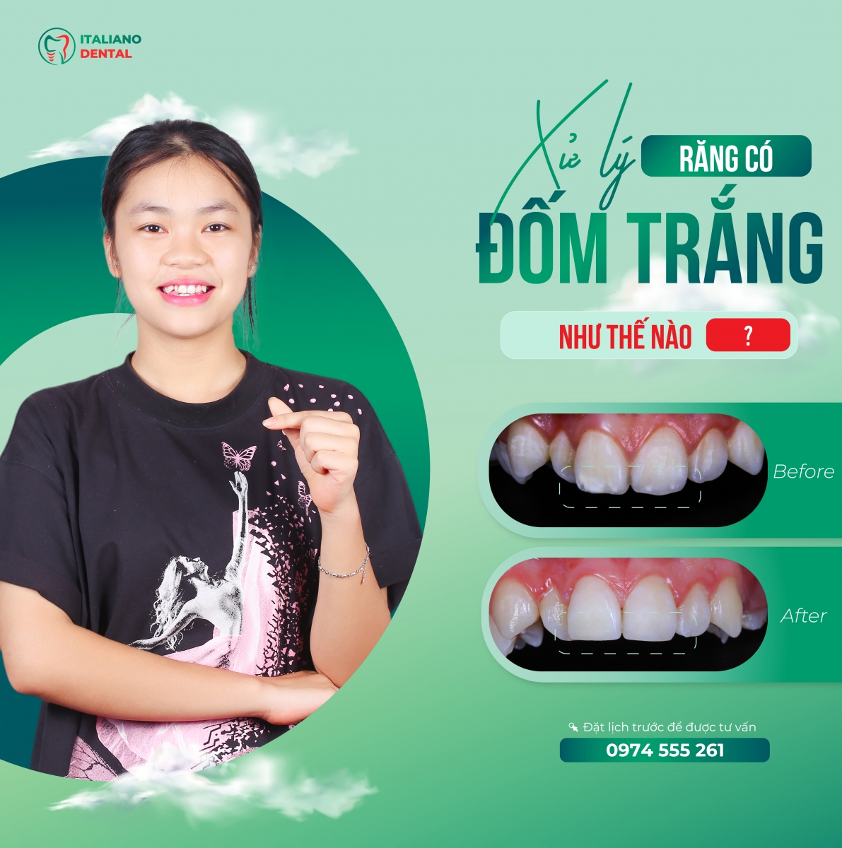 Giải pháp đột phá trong điều trị các đốm trắng trên răng