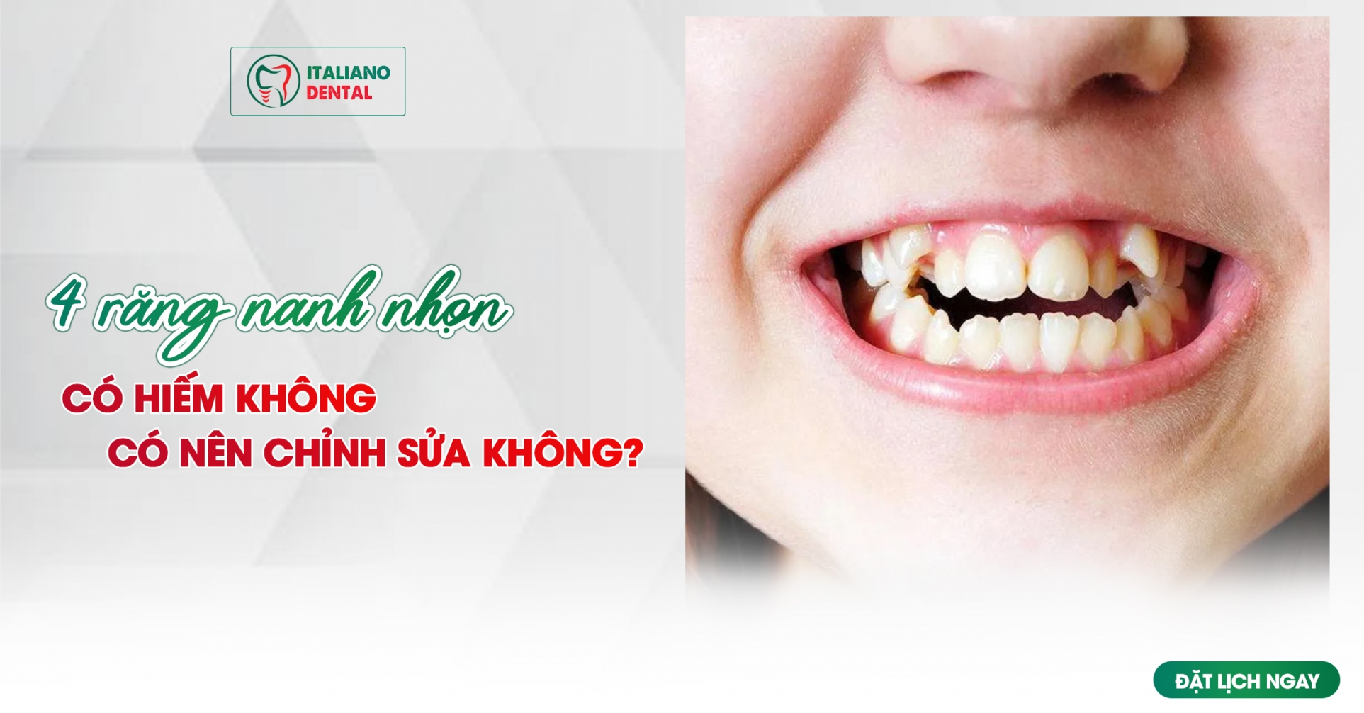 4 răng nanh nhọn có hiếm không? Có nên chỉnh sửa không?