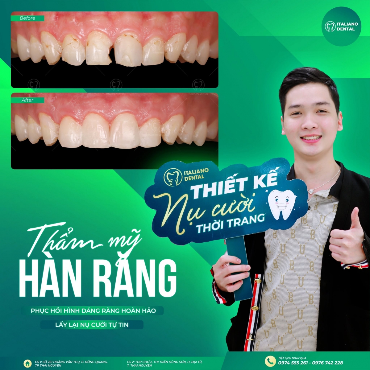 Khôi phục nụ cười với phương pháp trám răng