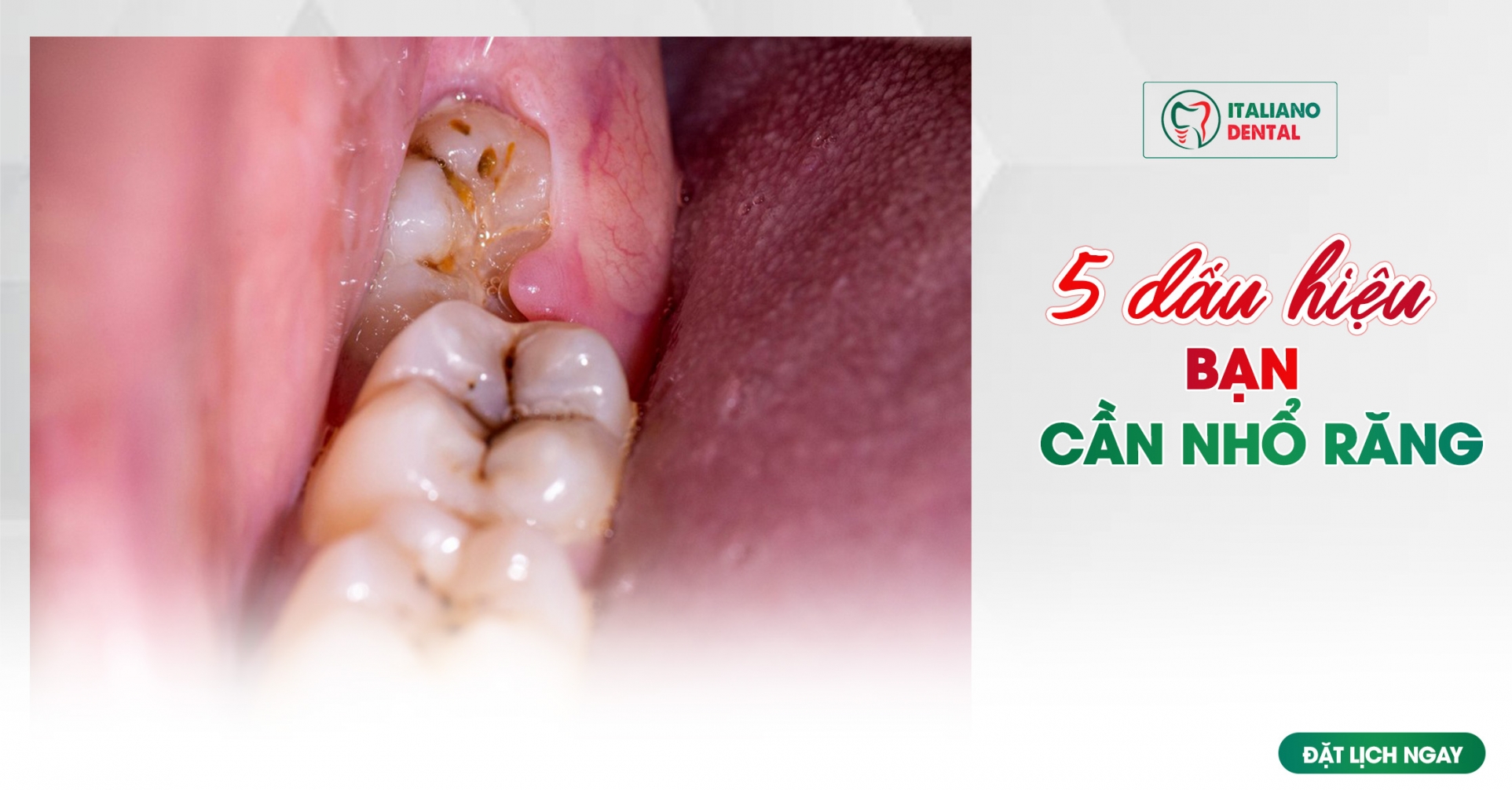 5 dấu hiệu cho thấy bạn cần nhổ răng