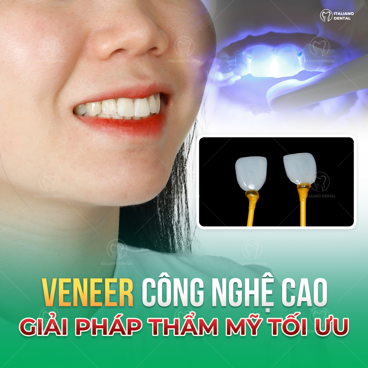 Dán sứ veneer: Giải pháp không xâm lấn giúp biến đổi nụ cười của bạn