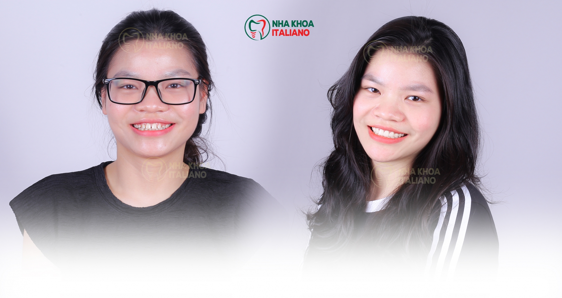 Dán sứ VENEER không mài răng tại Bắc Ninh