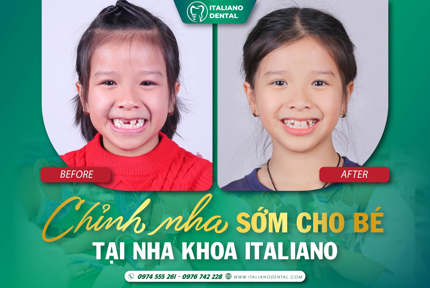 Các điều trị tiền chỉnh nha: Thủ thuật nha khoa trước khi bắt đầu chỉnh nha