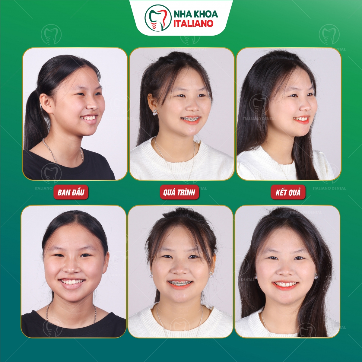 Nắn chỉnh nụ cười của bạn một cách dễ dàng với Italiano