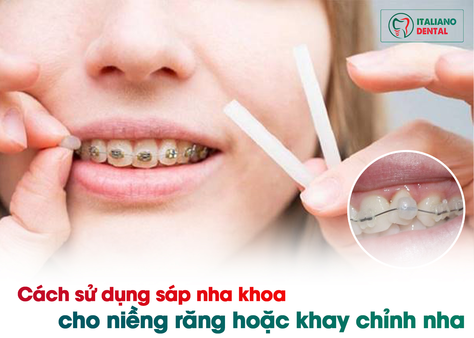 Cách sử dụng sáp nha khoa cho niềng răng hoặc khay chỉnh nha