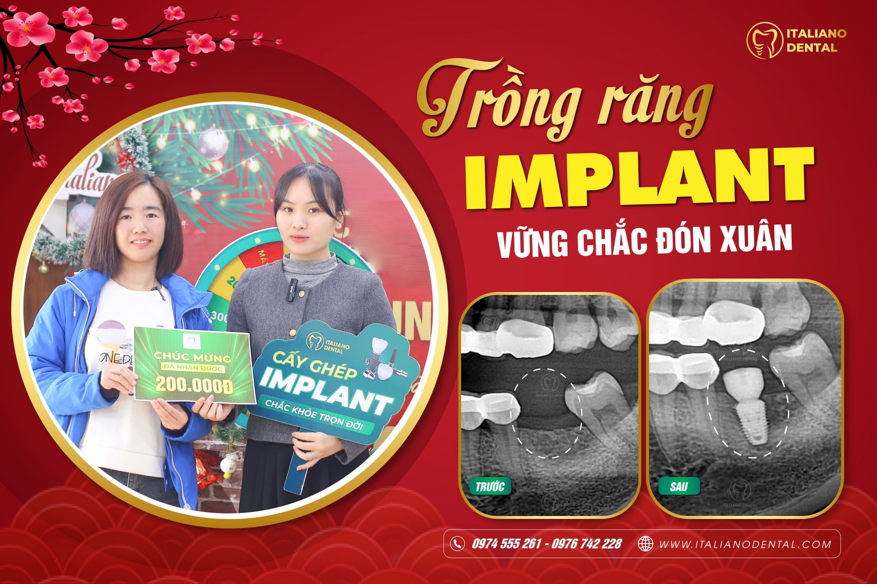 Cẩm nang toàn diện về cấy ghép Implant nha khoa 