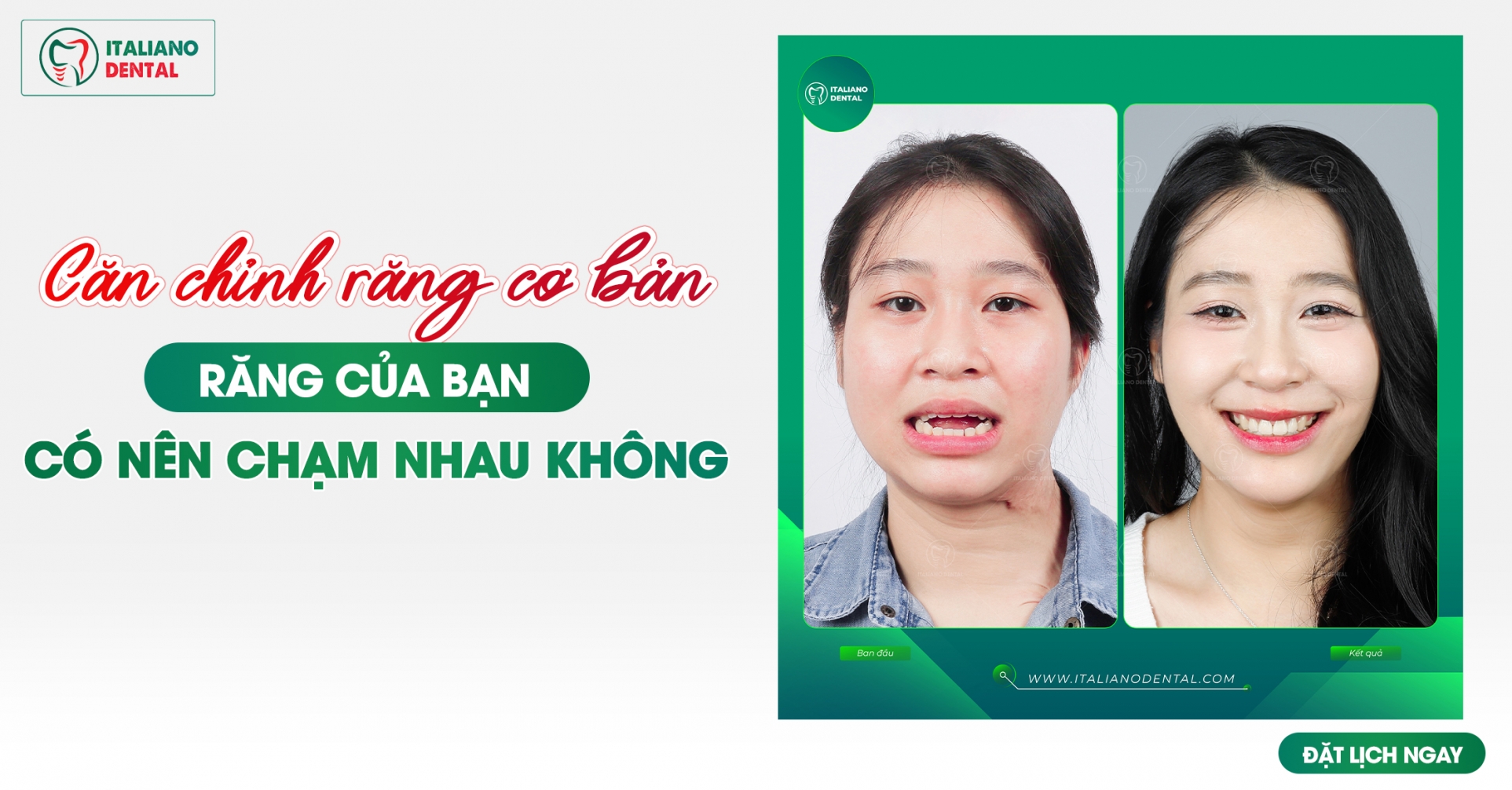 Căn Chỉnh Răng Cơ Bản: Răng Của Bạn Có Nên Chạm Nhau Không?
