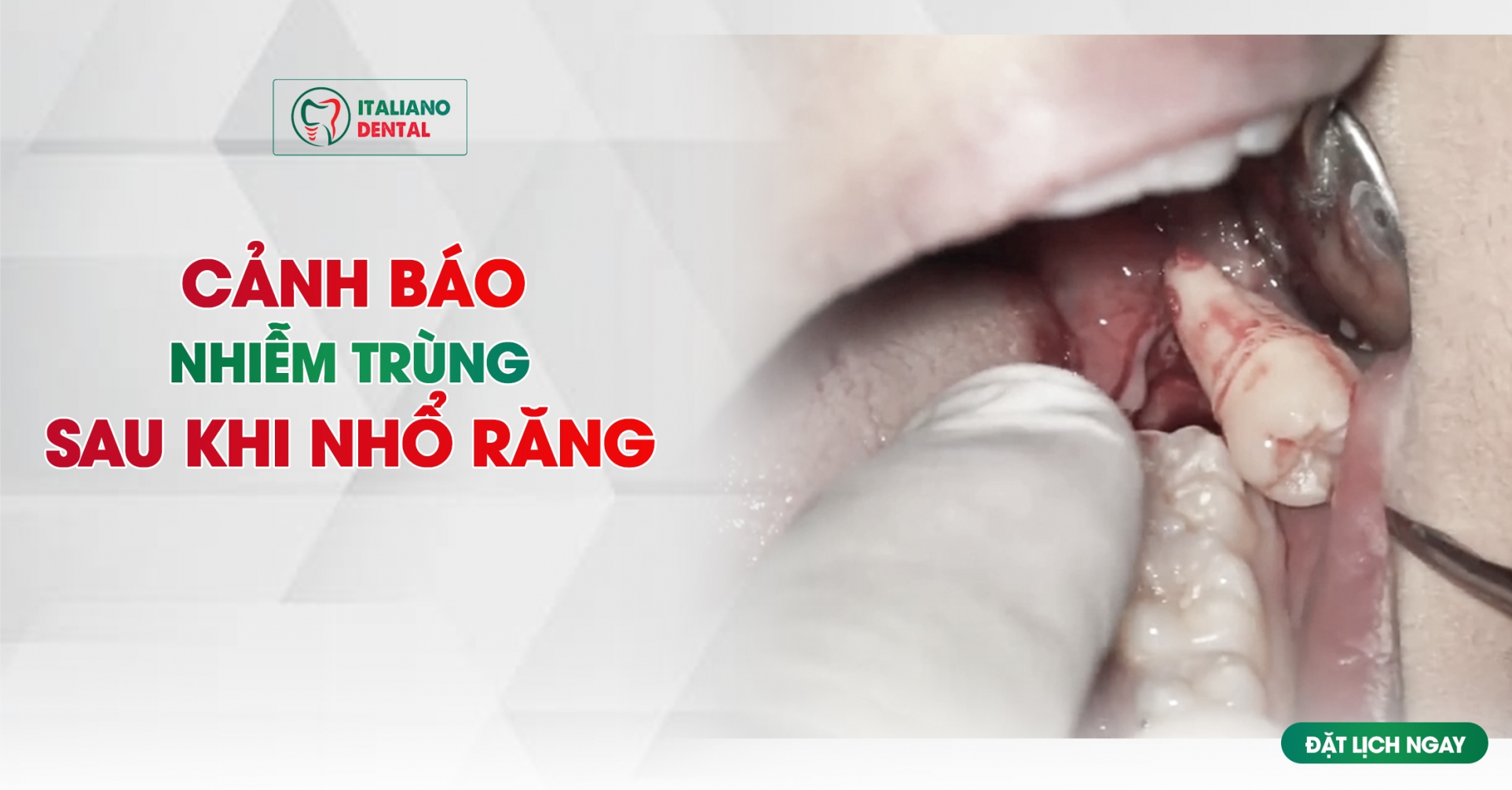 Nhiễm trùng sau khi nhổ răng: Những dấu hiệu cảnh báo cần theo dõi