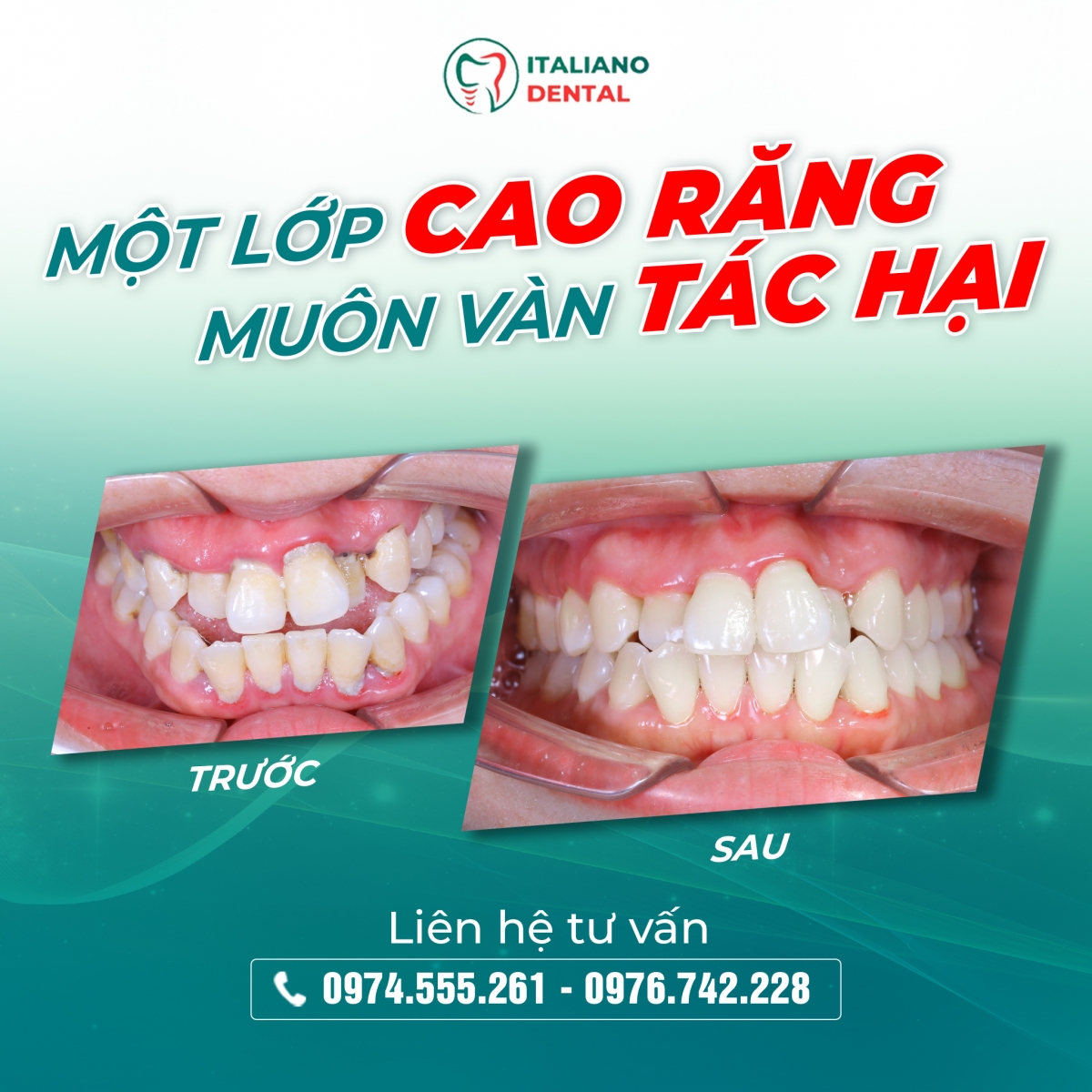 Lấy cao răng có làm mòn men răng hay không