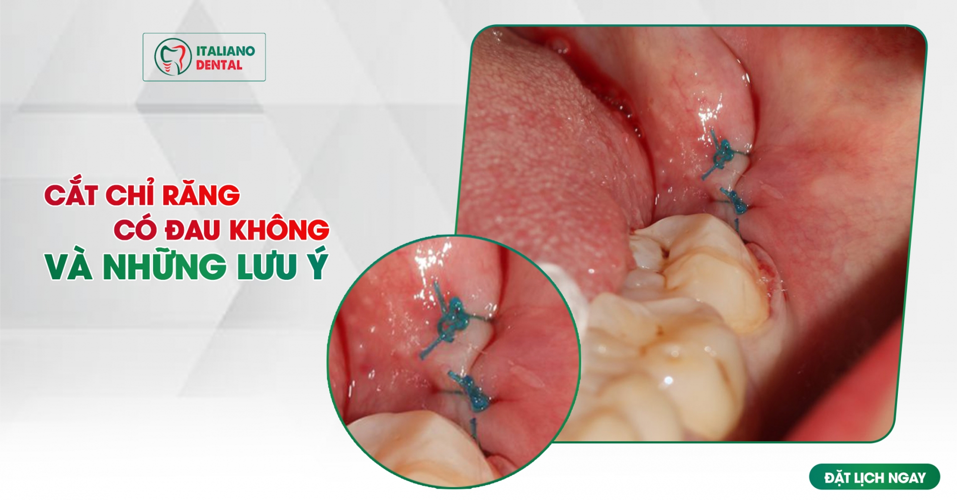 Cắt chỉ nhổ răng khôn có đau không? Những điều cần lưu ý sau khi cắt chỉ