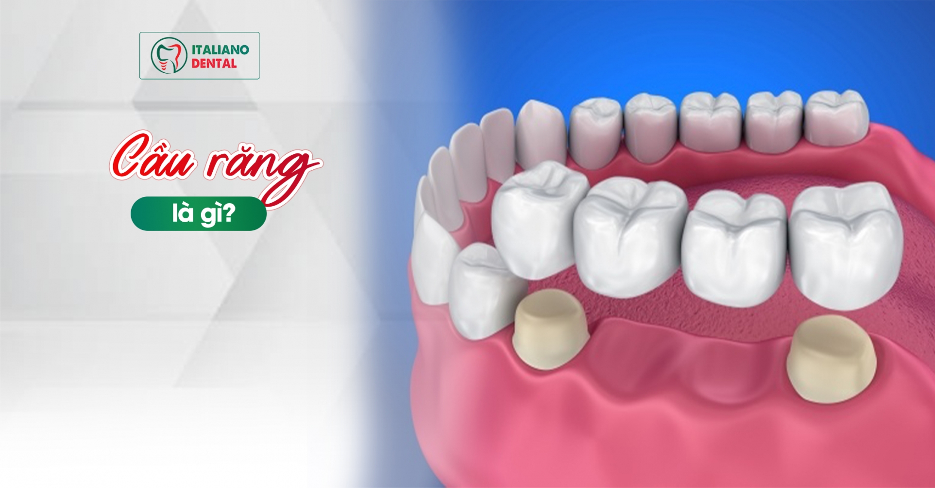 Bước tiến đến sức khỏe răng miệng tốt hơn: Tìm hiểu về cầu răng