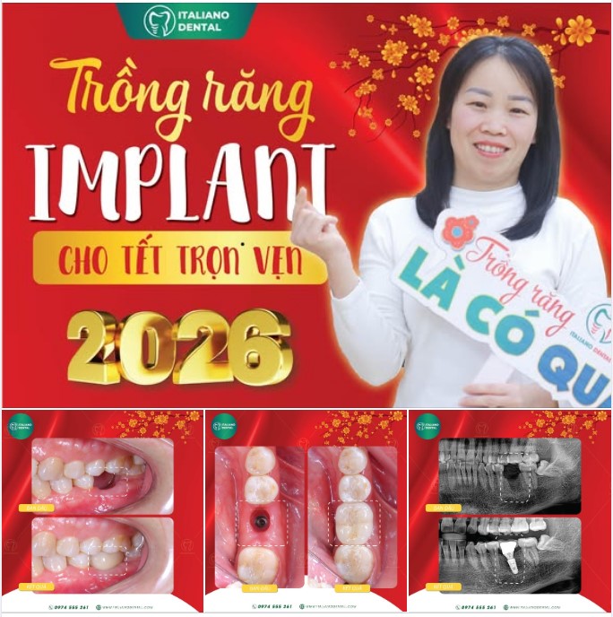 Cấy ghép implant có cảm giác như răng thật không? Những điều bạn cần biết