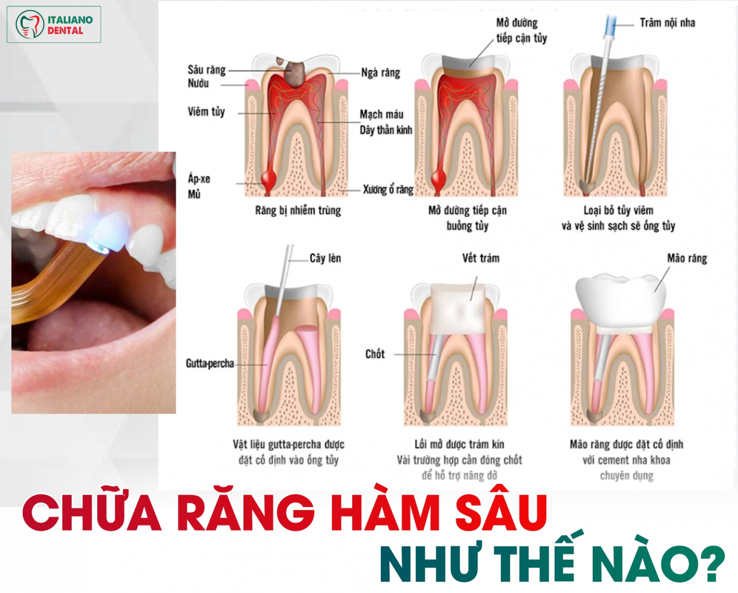 Chữa răng sâu răng hàm như thế nào
