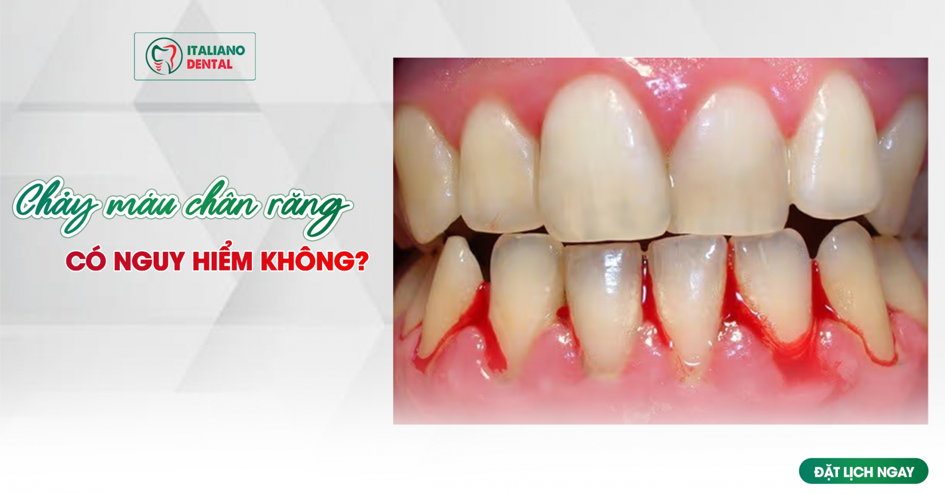 Chảy máu chân răng có nguy hiểm không