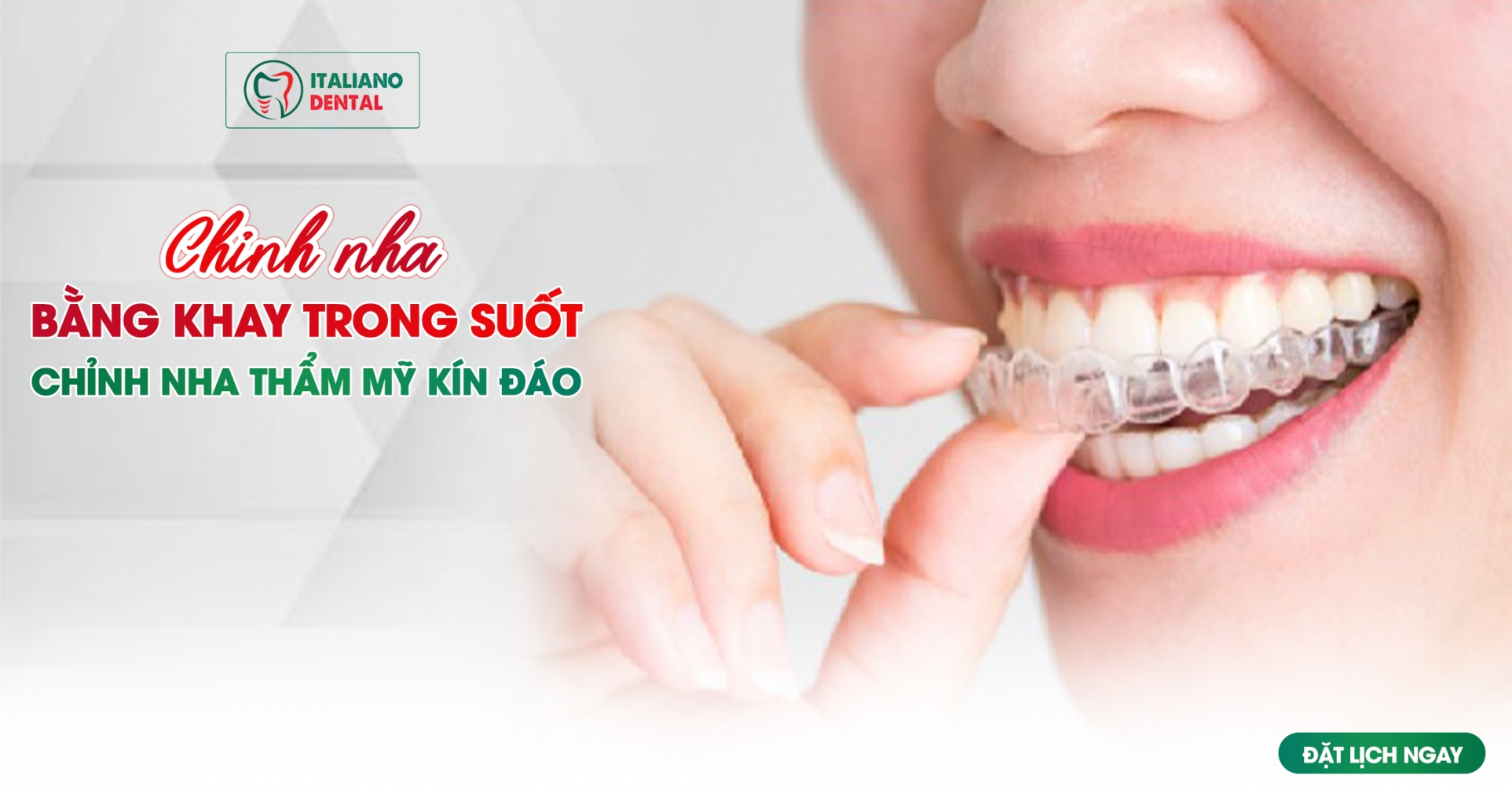 Chỉnh nha bằng khay trong suốt- Cách chỉnh nha kín đáo và thẩm mỹ