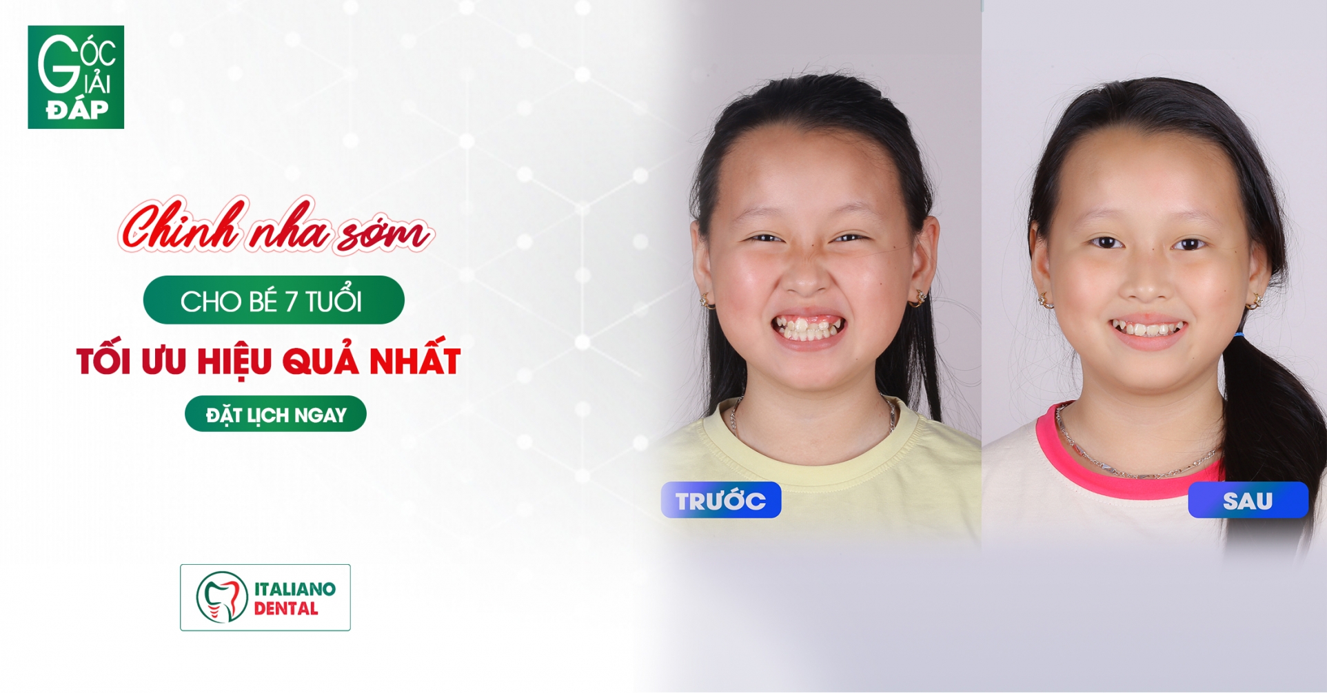 Giải pháp tối ưu giúp điều trị hiệu quả và tiết kiệm chi phí chỉnh nha sớm cho trẻ 7 tuổi