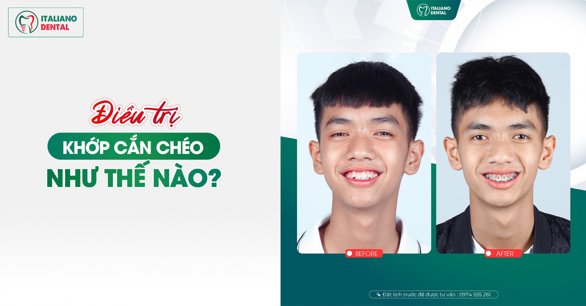 Hiểu Về Tật Cắn Chéo: Chúng Là Gì và Được Điều Trị Như Thế Nào?