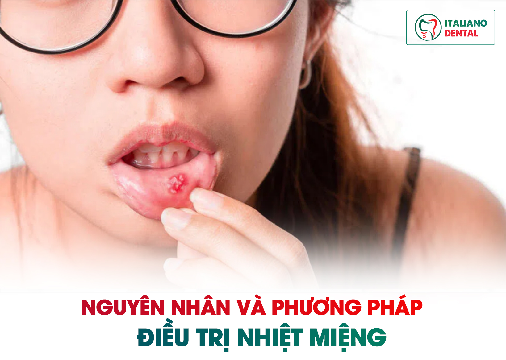 Nguyên nhân và phương pháp điều trị nhiệt miệng