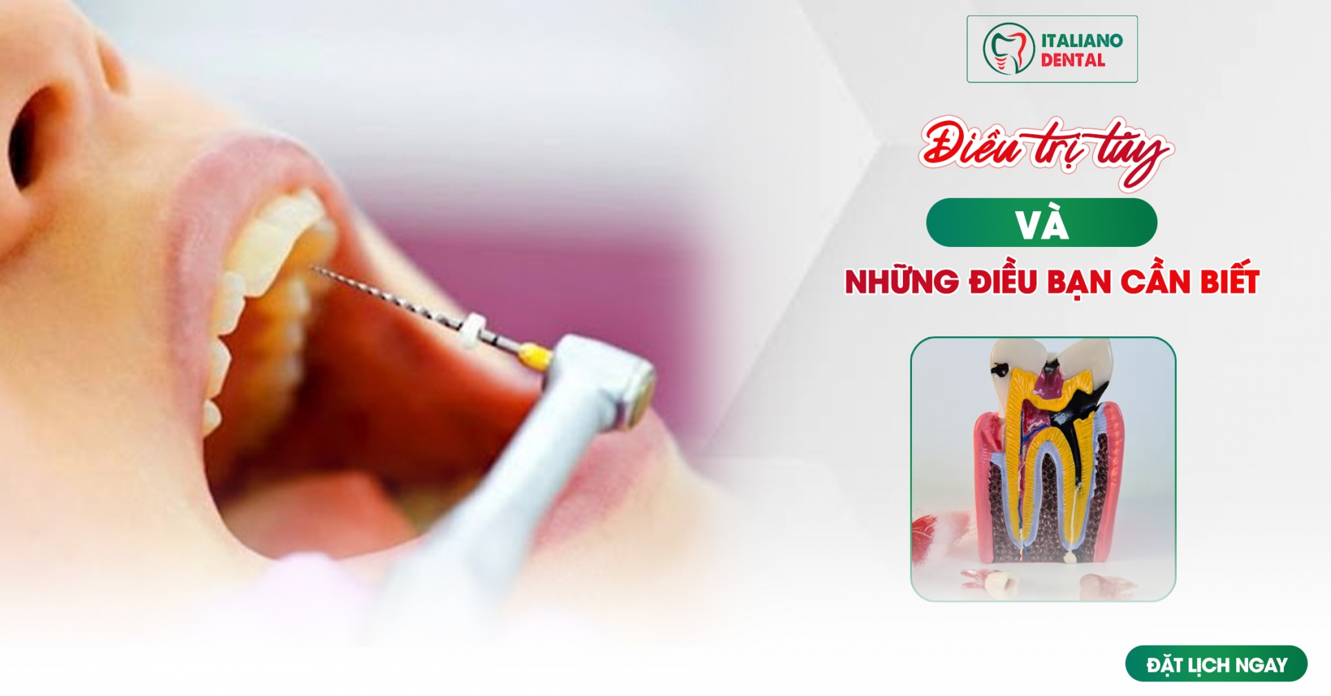 Điều trị tủy răng: Những điều bạn cần biết