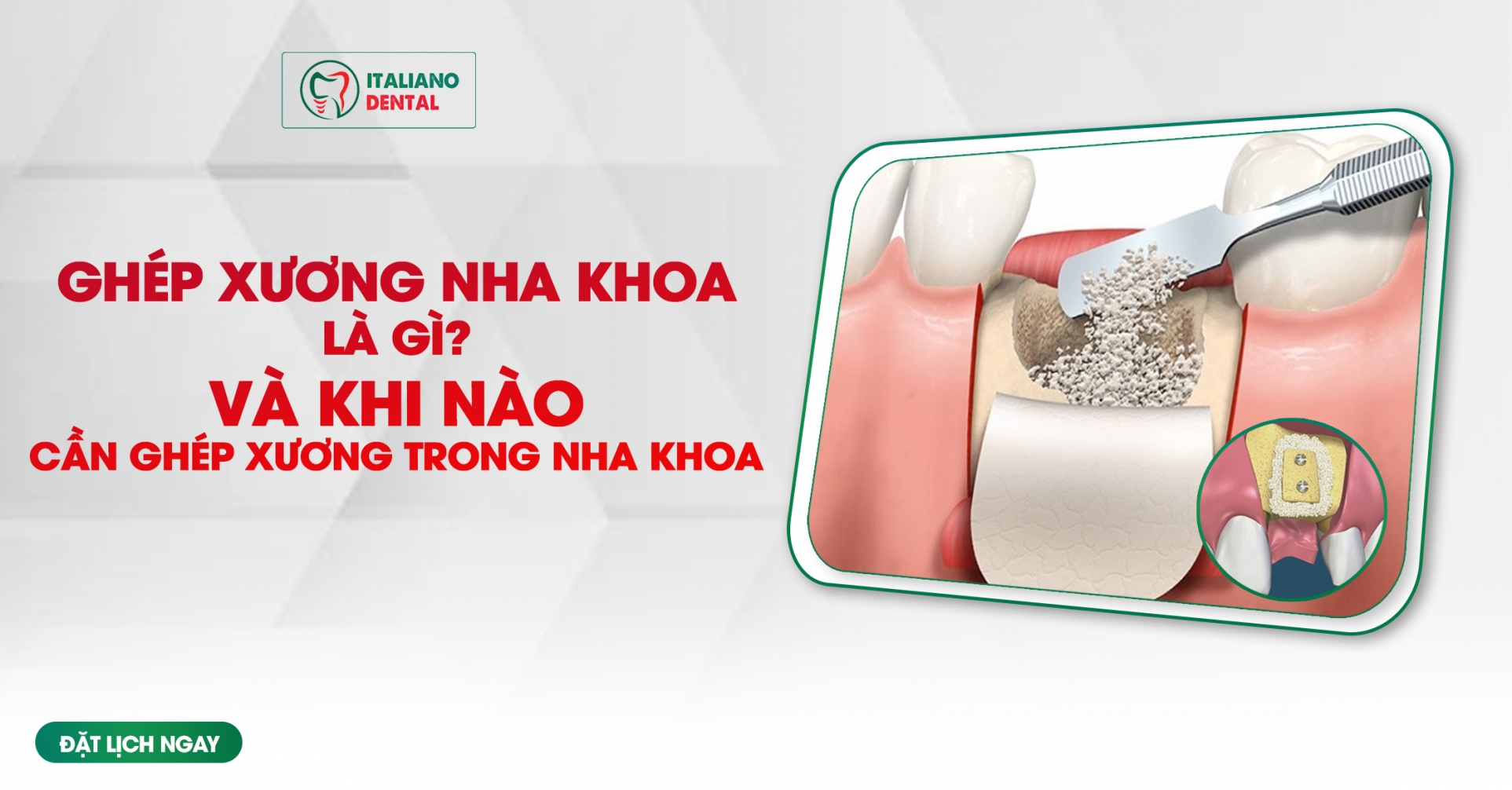 Ghép xương là gì? Khi nào cần ghép xương trong nha khoa- Giải đáp từ nha khoa Italiano