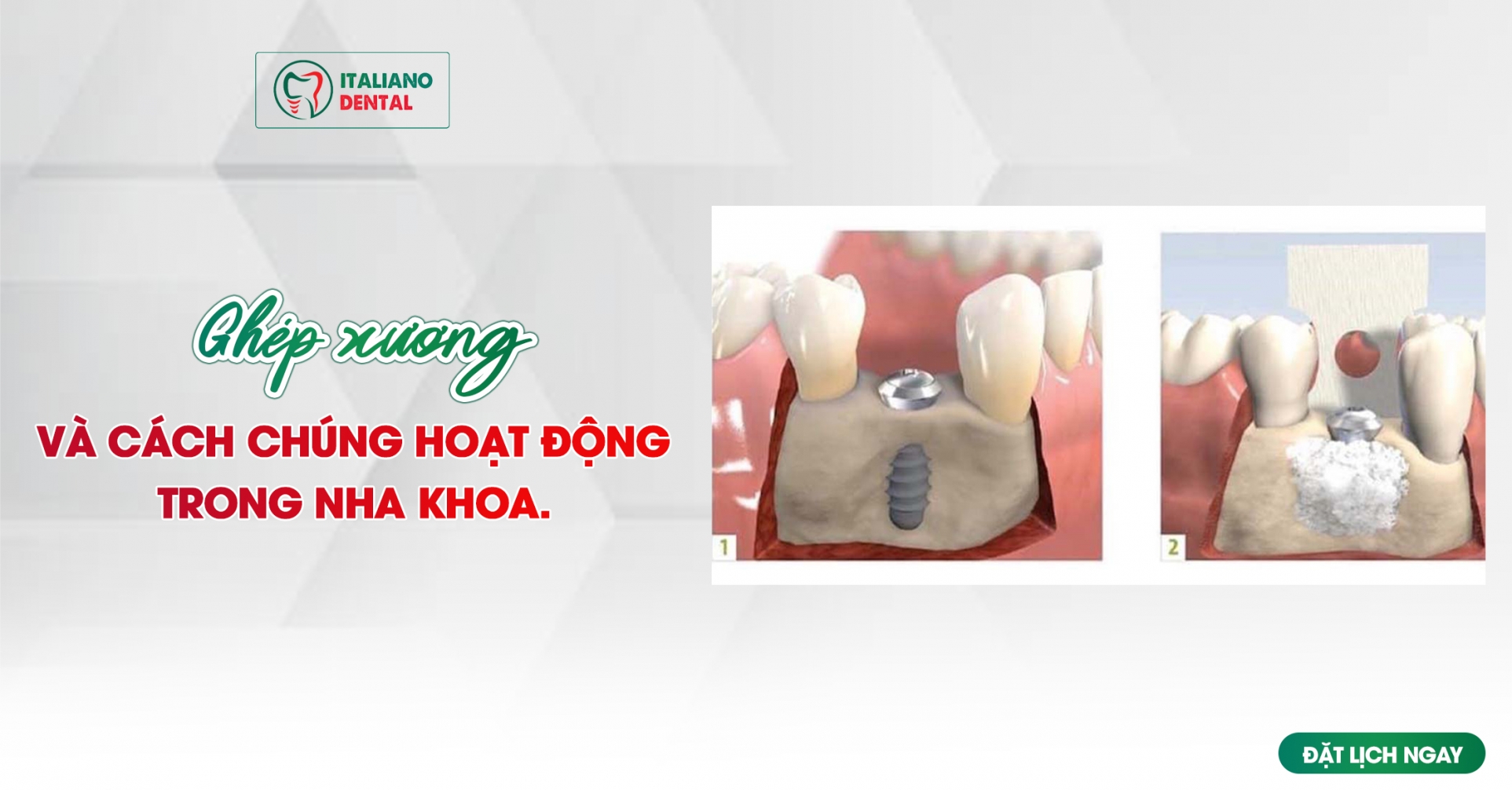 Khoa học đằng sau ghép xương: Cách chúng hoạt động trong nha khoa