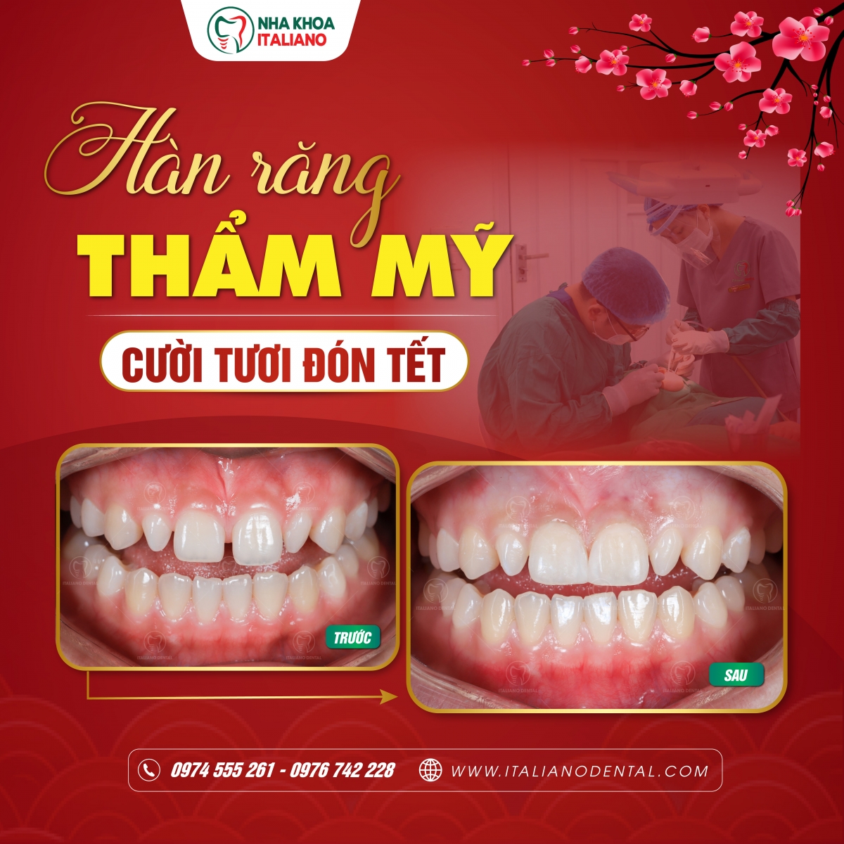 Trám răng thẩm mỹ (Composite Bonding) hay dán sứ Veneer