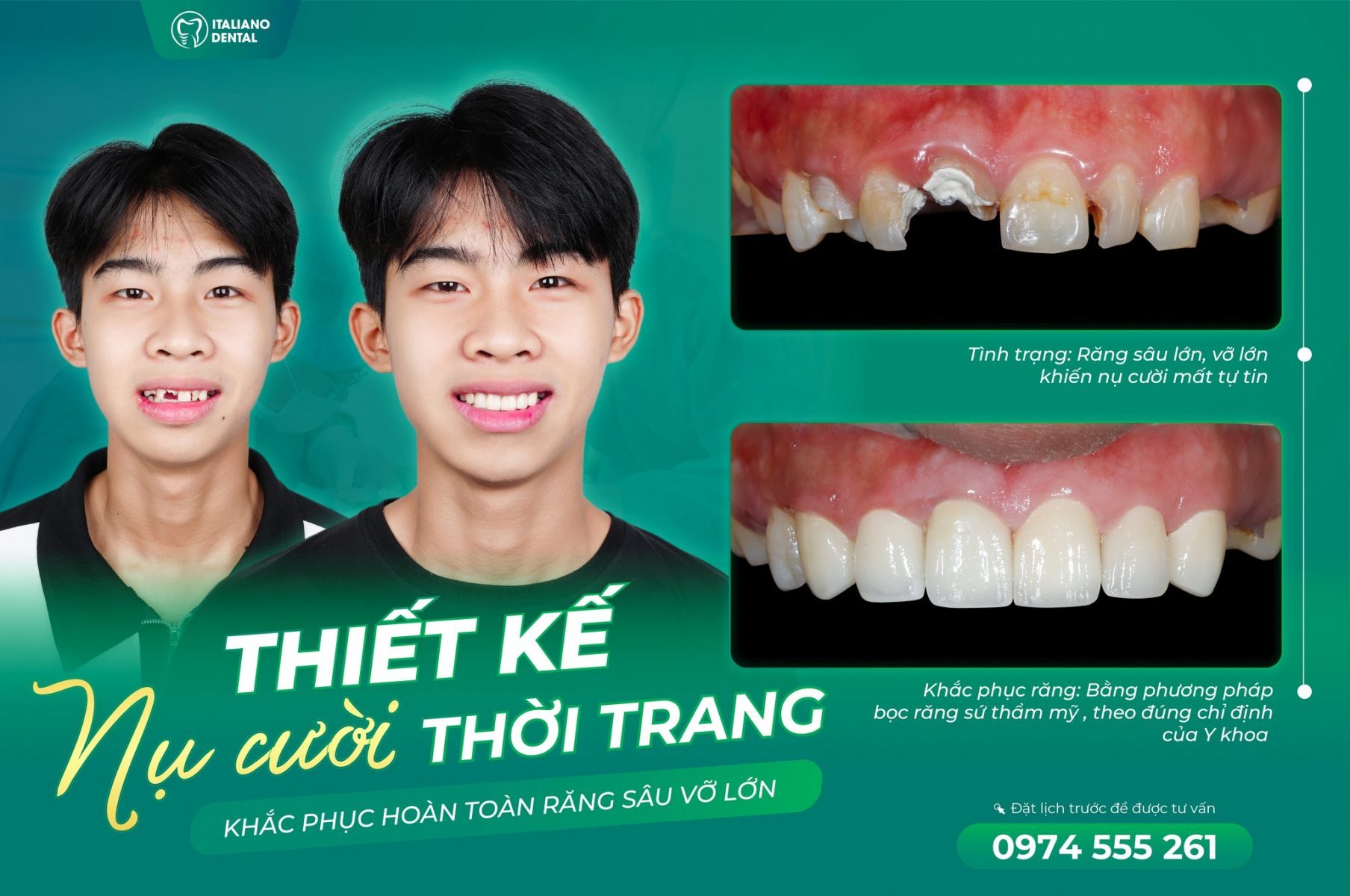 SÂU RĂNG, BIẾN CHỨNG CỦA SÂU RĂNG VÀ CÁCH ĐIỀU TRỊ