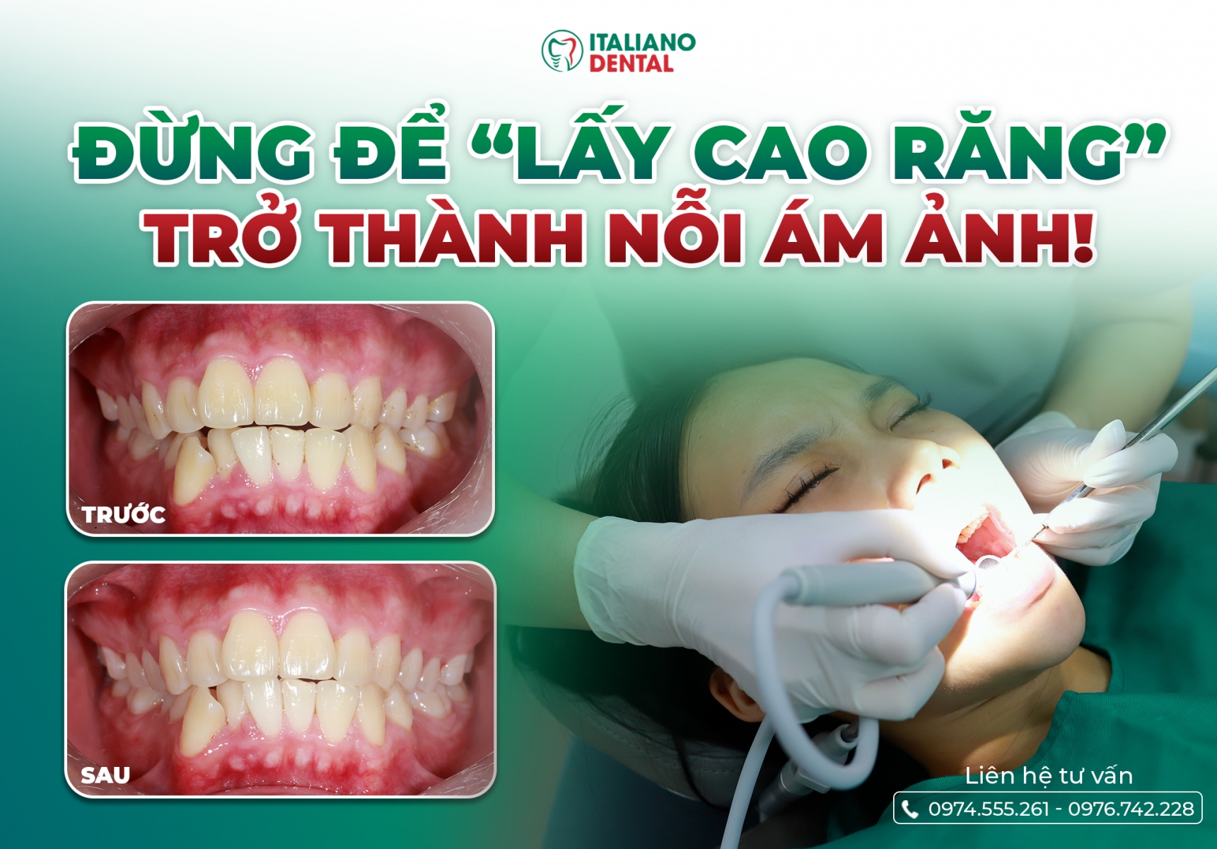 Bao lâu nên lấy cao răng 1 lần? Lời khuyên từ bác sĩ Nha khoa Italiano