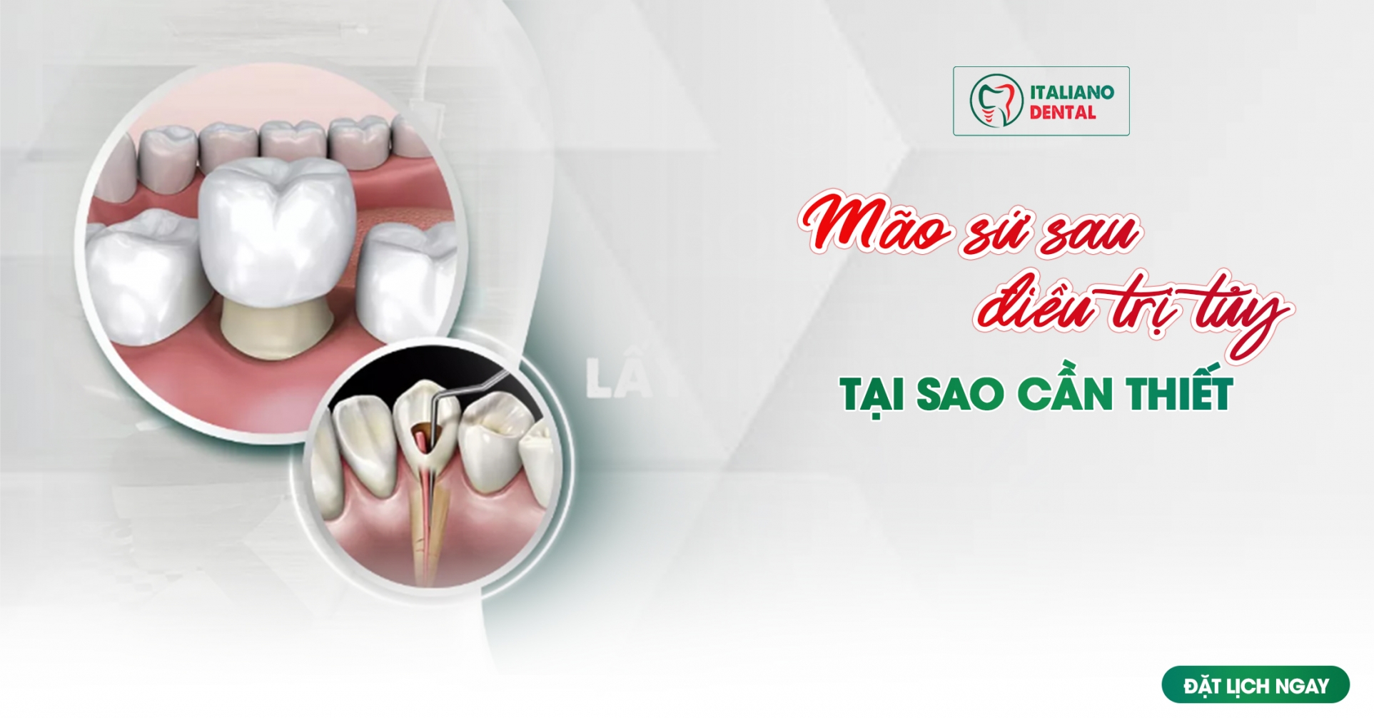 Mão răng sau điều trị tủy: Vì sao chúng thường cần thiết