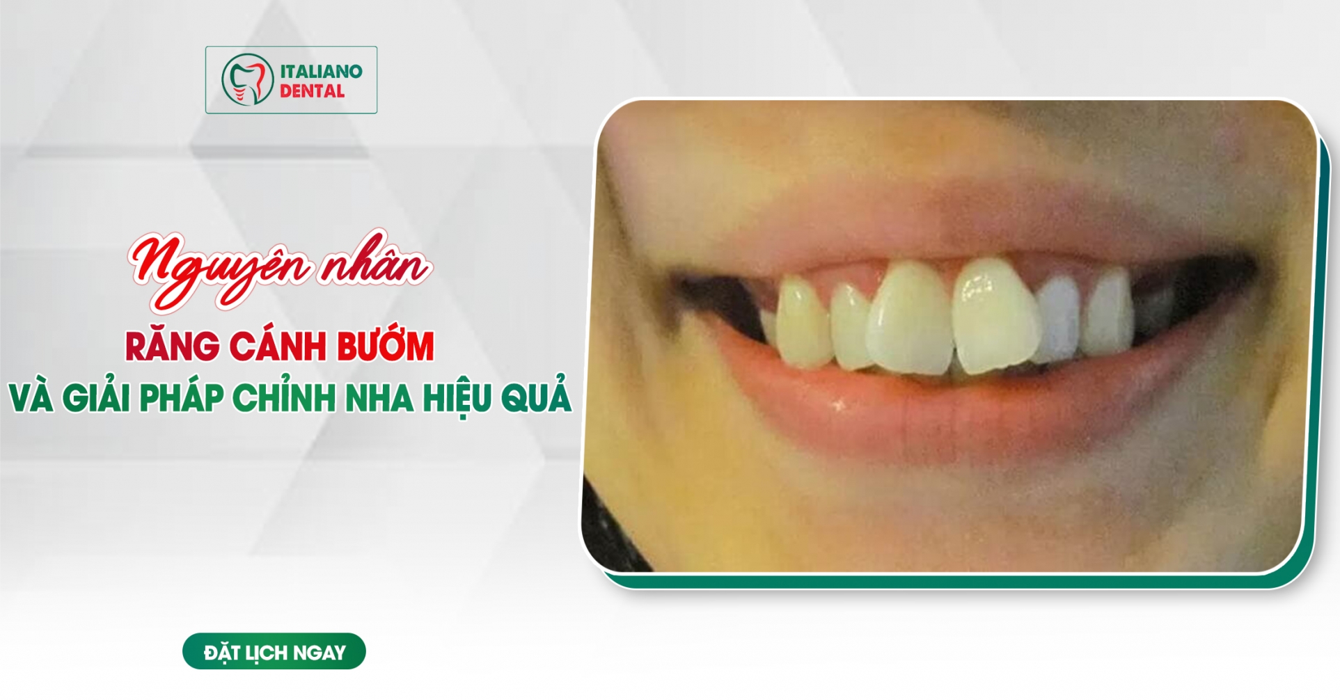 Nguyên nhân răng cánh bướm và giải pháp chỉnh nha hiệu quả