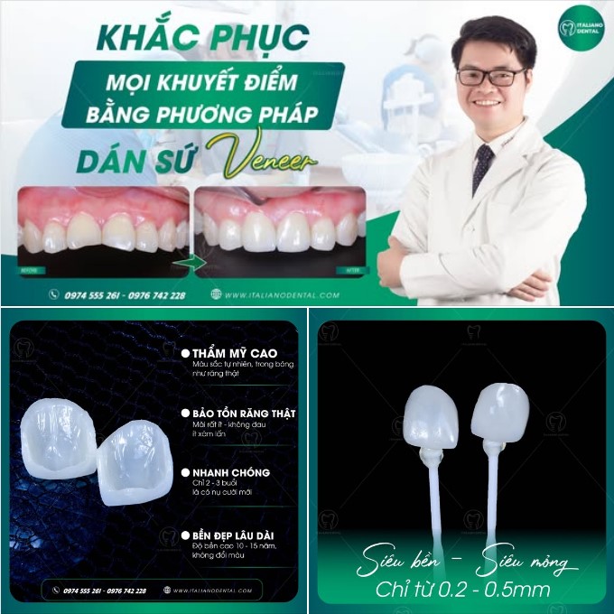 Dán sứ Veneer có bền không? Bao lâu phải thay?
