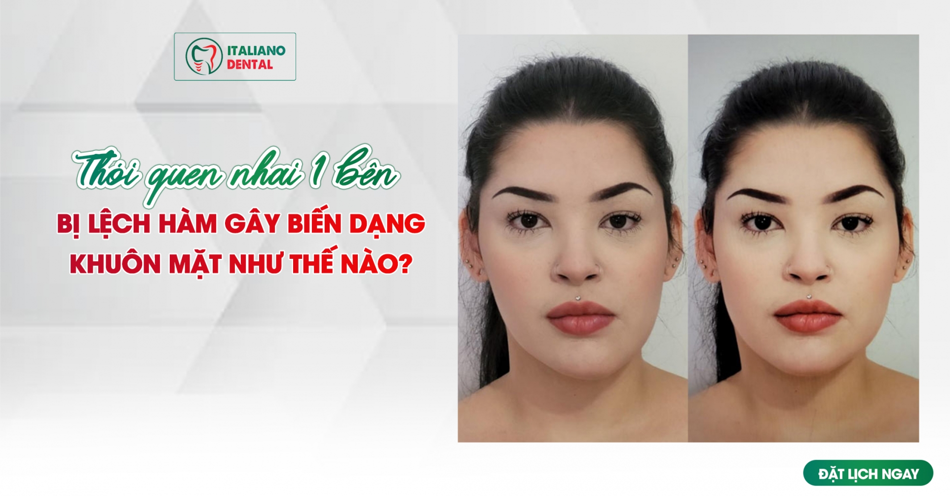 Thói quen nhai 1 bên bị lệch hàm gây biến dạng khuôn mặt như thế nào?